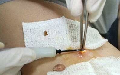 Tratamentul chirurgical al virusului papilomului uman