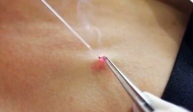 Îndepărtarea papiloma pe corp cu un laser
