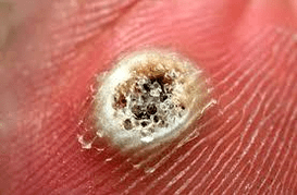 inflamaţie