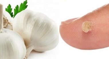 tratamentul verucilor cu remedii populare