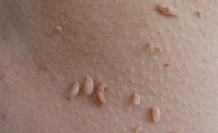 motivele apariției papiloamelor pe corpul uman