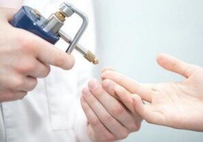 metode moderne de îndepărtare a papiloamelor