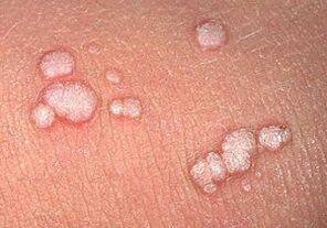 papiloame vulgare pe corpul uman