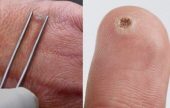 simptome de papiloame pe corpul uman