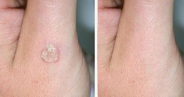 Fotografii înainte și după îndepărtarea negilor folosind remedii naturale