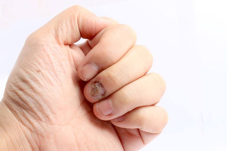 indicație de utilizare Keramin - ciuperca unghiilor